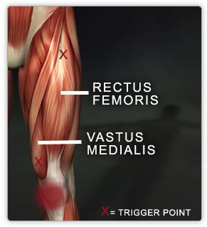 Rectus Femoris